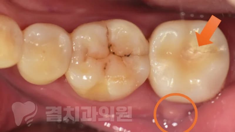 발치하라는데 임플란트는 언제 할까 — 부산 발치 즉시 임플란트, 되는 경우와 아닌 경우 (IBS 매직코어)