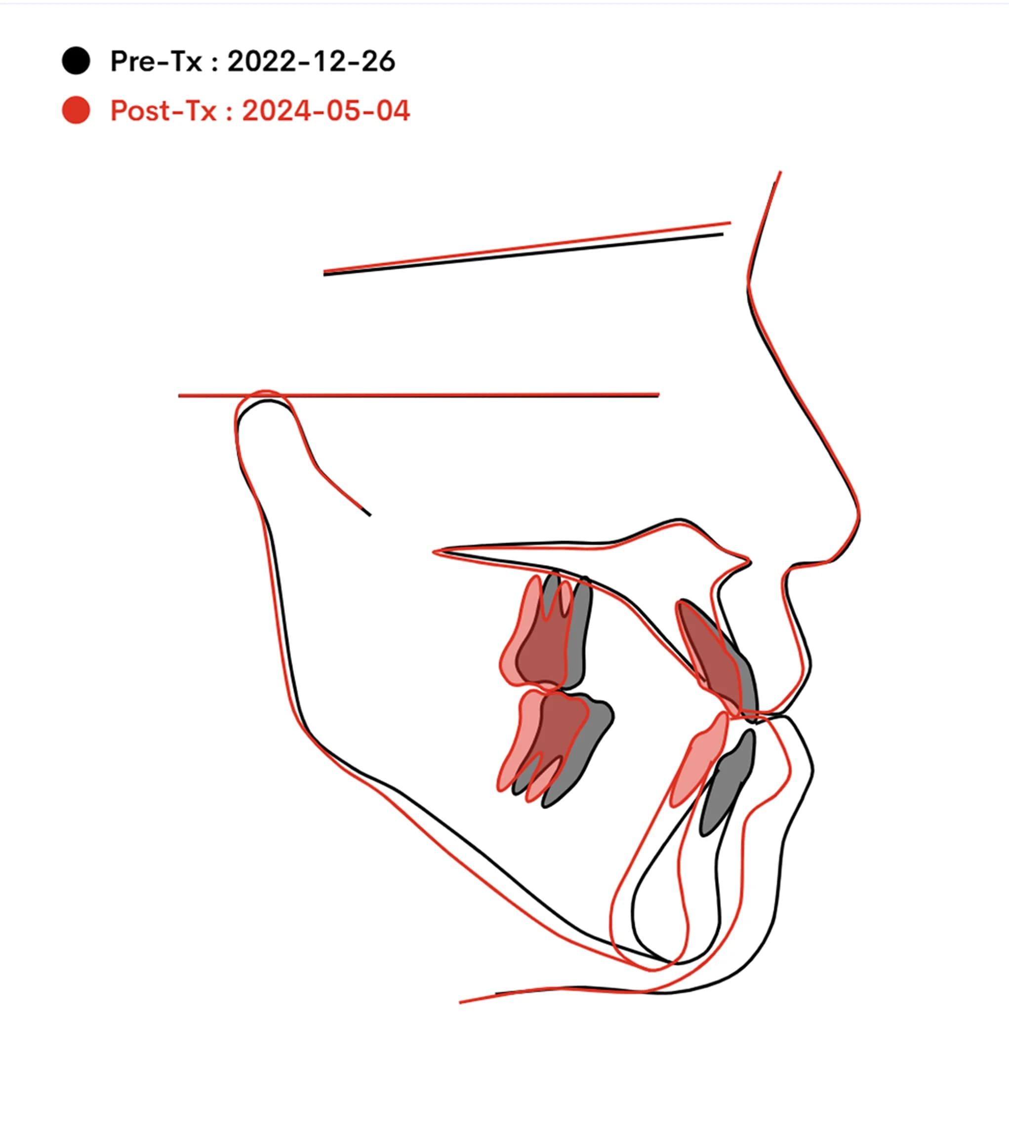 11세 아이의 반대교합 — "성인 되면 양악수술 하세요"라는 말을 듣고 오셨다면