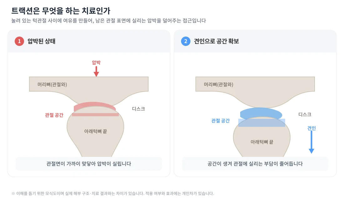 압박되어 관절면이 맞닿은 턱관절과, 견인으로 관절 사이에 공간이 생긴 상태를 비교한 모식도