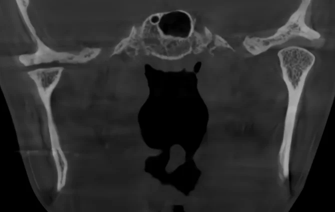CBCT 관상면 영상으로 좌우 턱관절이 한 화면에 함께 보이는 사진