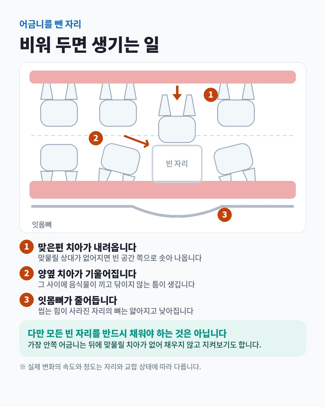 어금니를 뺀 자리를 비워 두면 생기는 변화 — 맞은편 치아가 내려오고, 양옆 치아가 빈 공간 쪽으로 기울며, 잇몸뼈가 줄어듭니다.
